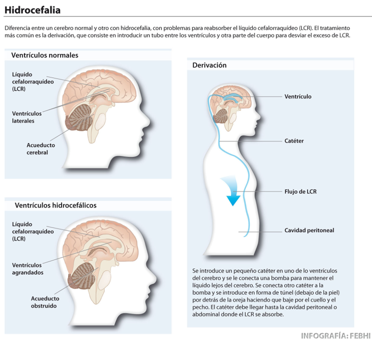 HIDROCEFALIA